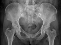 女性骨盆x光照片