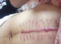 热 剖腹产的宝妈们都来晒晒刀疤