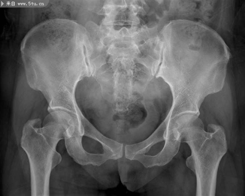 女性骨盆x光照片(点击浏览下一张趣图)